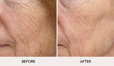 Micro Laser Peel- Osage Beach